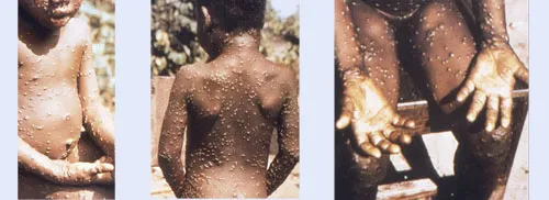 MPox Spreads Throughout Asia